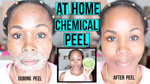 We did not find results for: How To Make A Natural Chemical Peel At Home Erase Acne Wrinkles Dark Spots Youtube