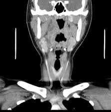 Image result for phlegmon on face)