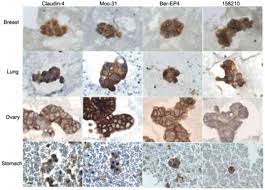 At the assessment, 17 were deemed optimal, 20 acceptable, 8 borderline and 3 poor (see left diagram). Anti Epcam Antibodies For Detection Of Metastatic Carcinoma In Effusions And Peritoneal Wash