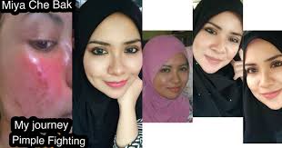 Balkhis abdul aziz is one of the panel doctors here that can perform medical screening for fomema. Pernah Dihina Kerana Alami Masalah Breakout Teruk Gadis Ini Kongsi Rawatannya Sebagai Persediaan Syawal Hijabista