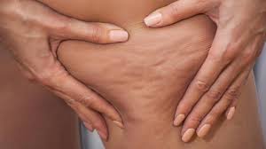 Cellulite Wer Sie Bekommt Und Was Dagegen Hilft Stern De