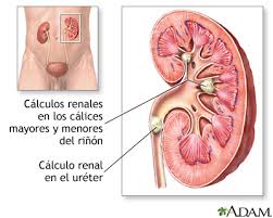 Image result for Calcium Nephrolithiasis