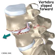 Image result for Pedistylis