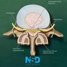 The ligamenta flava (singular, ligamentum flavum, latin for yellow ligament) are a series of ligaments that connect the ventral parts of the laminae of adjacent vertebrae. Hypertrophy Of Ligamentum Flavum Cause Of Pain And Disabilty