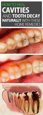 How To Heal Cavities And Tooth Decay Naturally With These Home Remedies Heal Cavities Tooth Decay Dental Health Care