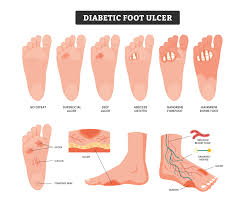 Image result for black toe diabetes