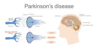 The campalgn study of parkinson's disease: Parkinson S Disease Apollo Hospitals Blog