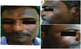 Dr Arjun Joseph Kuruvilla* Dr Chaithra Shankar INTERNATIONAL JOURNAL OF  SCIENTIFIC RESEARCH ABSTRACT KEYWORDS