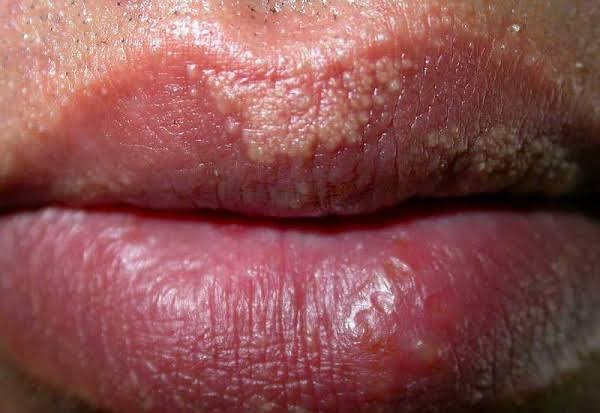 Mụn trắng ẩn dưới da môi có nguy hiểm không và loại bỏ như nào - VIETSKIN