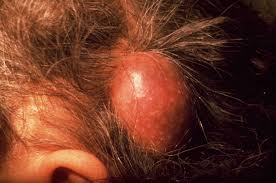 Your doctor can offer you guidance on how long you need to reduce your activity levels, and he or she may be able to suggest alternative forms of exercise you can do in the meantime. Overview And Treatment Of Sebaceous Cysts
