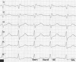 Understanding electrocardiography, st louis, 1980; Reverse Takotsubo Kardiomyopathie Eine Lebensbedrohliche Erkrankung Springerlink
