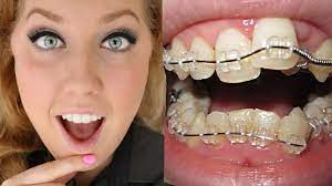 How long does botox take to work? Braces Before And After Timelapse Transformation Ashley Craig Youtube
