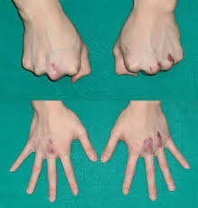 Image result for Elson Extensor Tendon Test