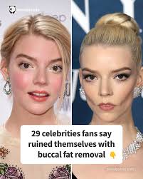29 Celebrities fans say ruined themselves with buccal fat removal (link in  the comments)