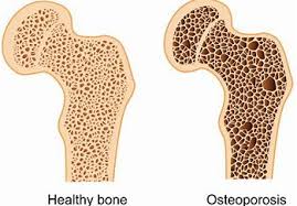 Most yoga studios and gyms offer mats, but many yoga students prefer to buy a mat, for hygiene and because. Rowing Or Yoga To Build Bone Density