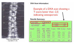 Reading A Dxa Scan