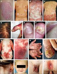 Image result for psoriasis