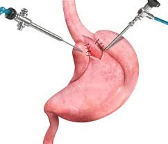 Laparoscopic anti-reflux surgery