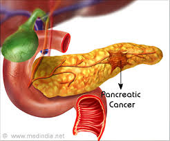 Treatment of pancreatic cancer is based on establishing what stage the cancer is in. New Blood Test Can Quickly Detect Pancreatic Cancer