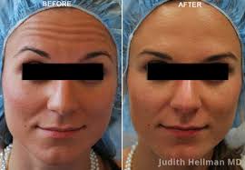 Maybe you would like to learn more about one of these? Botox Injections In Nyc Botox Specialist New York