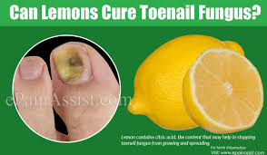 can lemons cure toenail fungus how
