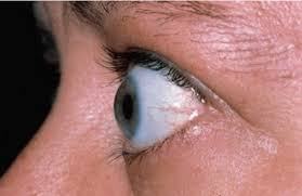 Image result for Proptosis