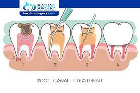 How long after a root canal can you eat solid food? Root Canal Pain Root Canal Pain Level Throbbing Pain After Root Canal