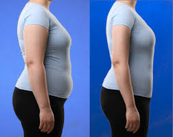 Image result for Liposuction