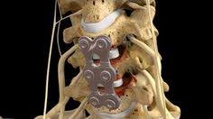 C5 6 C6 7 Anterior Cervical Discectomy With Fusion Spinal Fusion Acdf Surgery Spinal Surgery