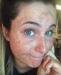 Vitiligo (weißfleckenkrankheit, pigmentflecken) ist eine erkrankung, die zur bildung weißer flecken auf der haut führt. 15 Pigmentflecken Ideen In 2021 Pigmentflecken Flecken Pigmentflecken Gesicht