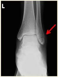 Broken Ankle X Ray Broken Ankle Broken Fibula Ankle Fracture