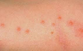 What Cause Small Red Itchy Bumps On Skin Http Www Flacheya Com What Causes Small Red Itchy Bumps On Skin Bed Bugs Bites Skin Bed Bug Bites Itchy Red Bumps