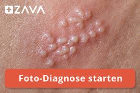 Genitalherpes kann sich auf weitere körperpartien ausbreiten. Symptome Von Genitalherpes Zava Dred