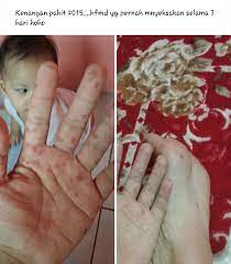 Cara mencegah penyakit tangan, kaki, dan mulut yaitu selalu melakukan gaya hidup sehat dengan. Kenangan Terkena Penyakit Hfmd Tanda Simptom Dan Apa Yang Perlu Dibuat Jika Terkena Hfmd Cikguzim