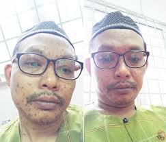 Chicken pox in infants do not often leave scar unless there is secondary bacterial infection. Wajah Selepas Chickenpox Menyerang