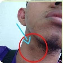 Bengkak di leher merupakan tanda pertama untuk kanser mulut, tekak, dan pita suara. Bengkak Di Leher Uito