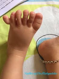 Jangan lupa untuk membookmark sakit ibu jari kaki sebelah kanan menggunakan ctrl d (pc) atau command d (macos). Polydactyly Bayi Mempunyai Lebih Daripada 5 Jari Kaki Dr Ahmad Mahyuddin Mohamed The Malaysian Medical Gazette