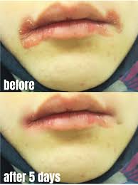 Image result for Angular Cheilitis