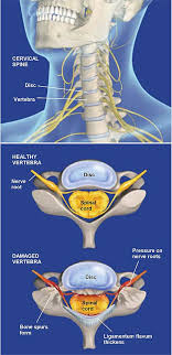 Στένωσις, contraído ) es un término utilizado para denotar la estrechez o el estrechamiento (patológico) de la luz. Estenosis Espinal Cervical Grupo Medico Ortopedico De La Costa Central