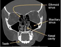 Most of this time is spent getting ready for the scan. Computed Tomography Ct Sinuses