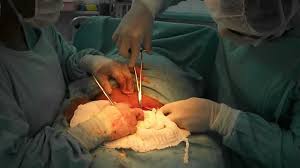 Resultado de imagem para imagem cirurgia cesaria