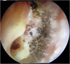 Image result for Acute Otitis Externa