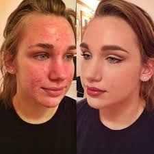 Before And After On My Beautiful Client Amazing Acne Coverage I Used Limelight Botanical Foundation In Olive 2 Acne Coverage Affordable Skin Care Acne Makeup