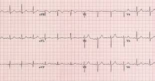 Elektrokardiogram (ekg) adalah grafik yang dibuat oleh sebuah elektrokardiograf, yang merekam aktivitas kelistrikan jantung dalam waktu tertentu. Cara Menentukan Axis Jantung Sumbu Jantung Pada Ekg Jantung Area