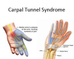 Image result for Carpal Compression Test
