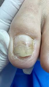 Image result for Onycholysis feet