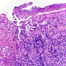 Cobblestone esophagitis (эзофагит со слизистой булыжной мостовой). Beverly Pathology On Twitter Concomitant Case Of Hsv And Cmv Esophagitis With Extensive Ulceration Pathology Pathologists Gipath