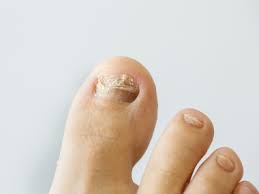 Image result for mykoza nehtů