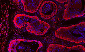 It's important to know about. New Study Reveals Weakness In Emerging Type Of Aggressive Prostate Tumor