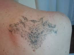 Tattoo removal is something we hope you'll never have to consider. Tattoo Removal Pure Beautiful
